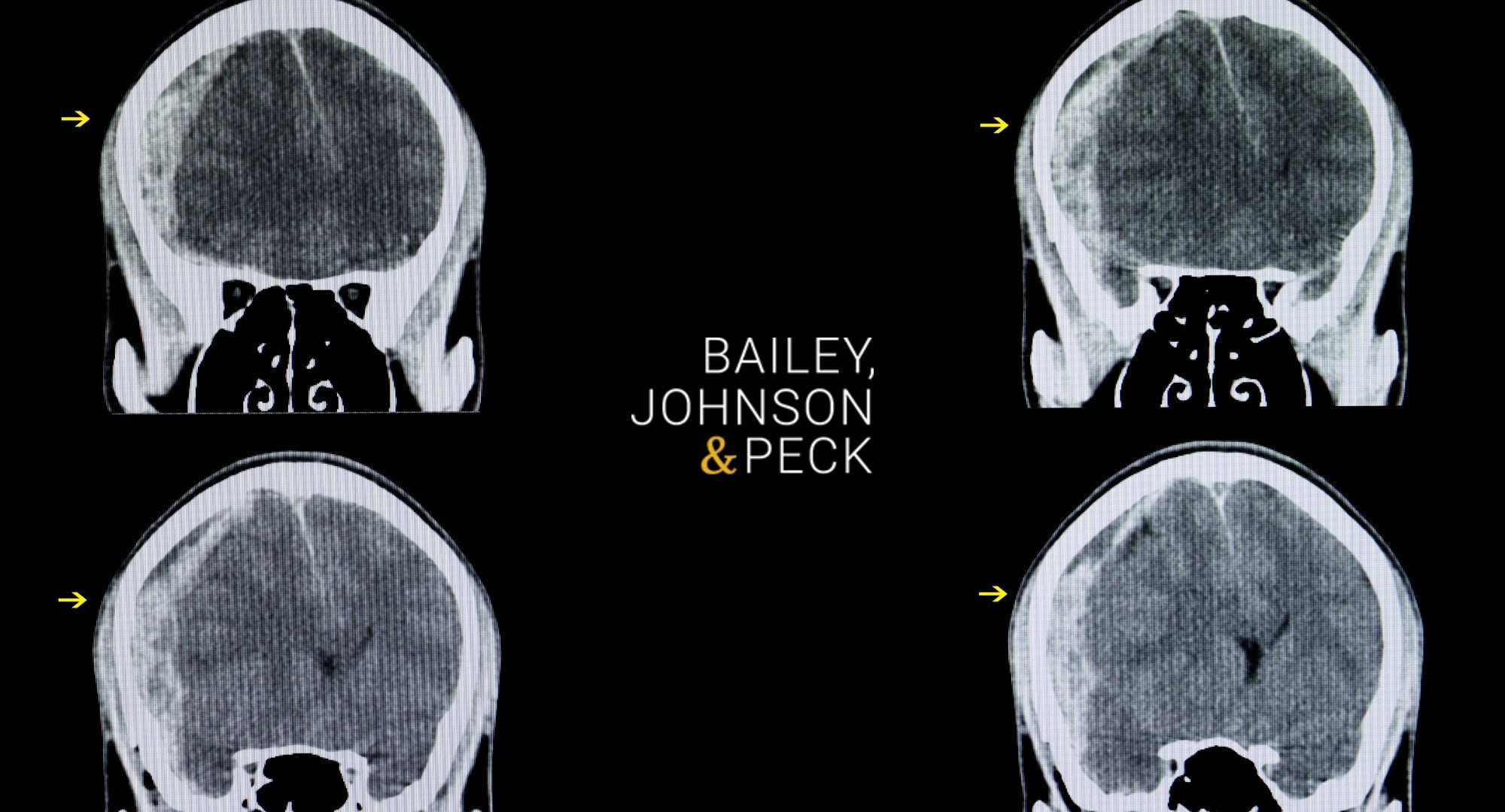 Albany Traumatic Brain Injury Lawyer | Bailey, Johnson & Peck, P.C.